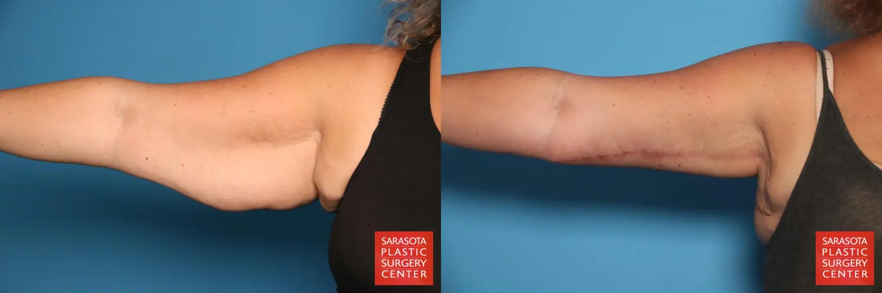 Arm Lift: Patient 39 - Before and After  