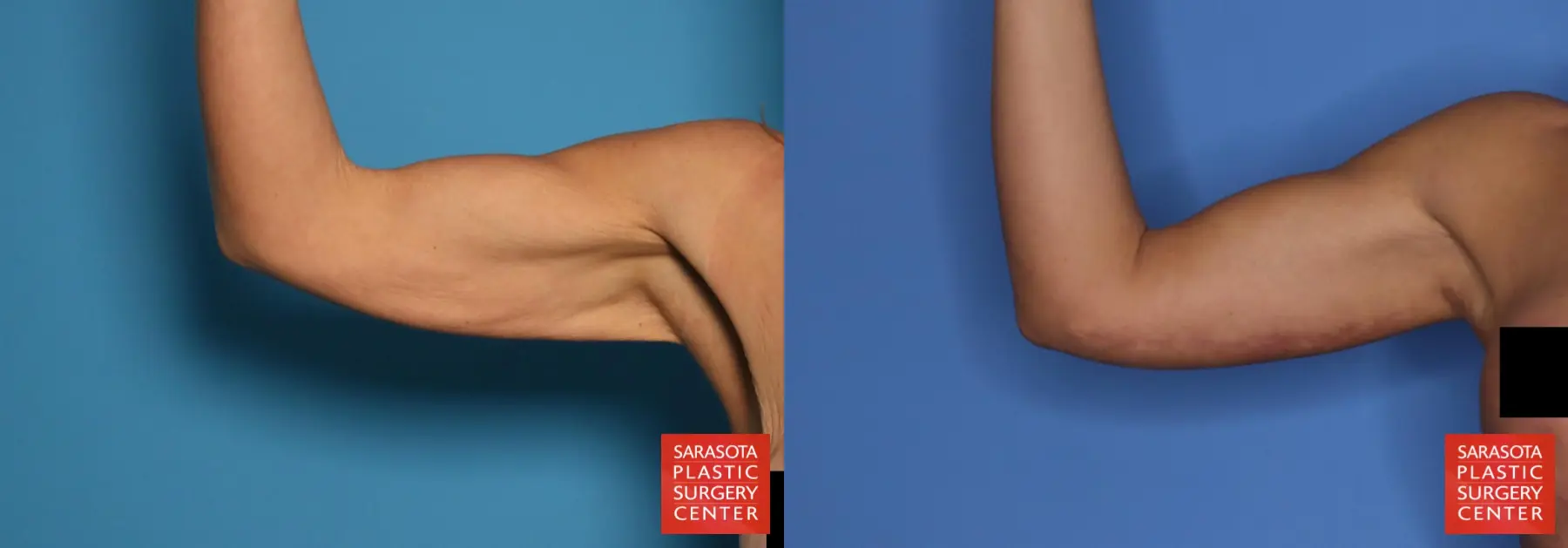 Arm Lift: Patient 27 - Before and After 2