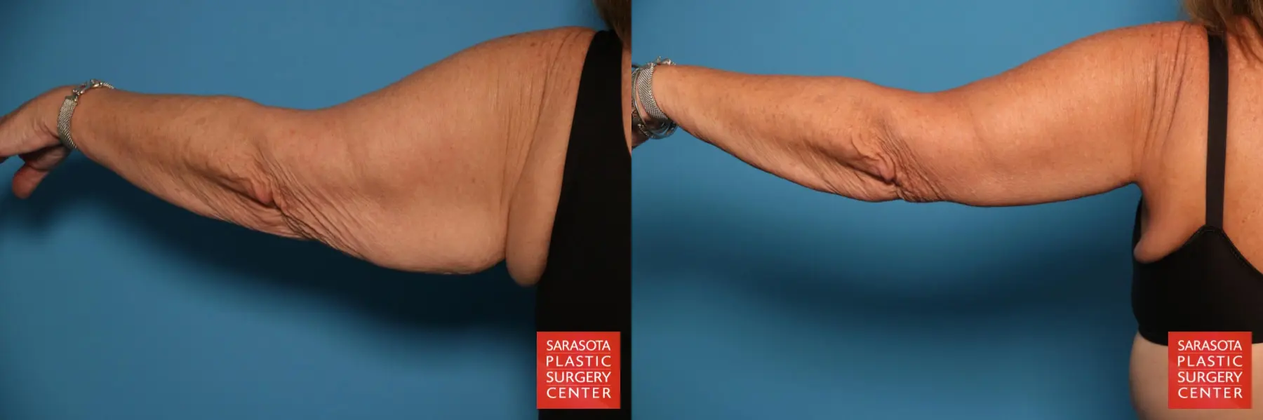 Arm Lift: Patient 23 - Before and After 5