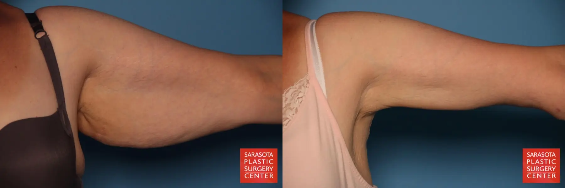 Arm Lift: Patient 25 - Before and After 3