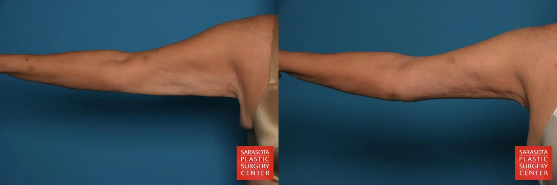 Arm Lift: Patient 34 - Before and After  