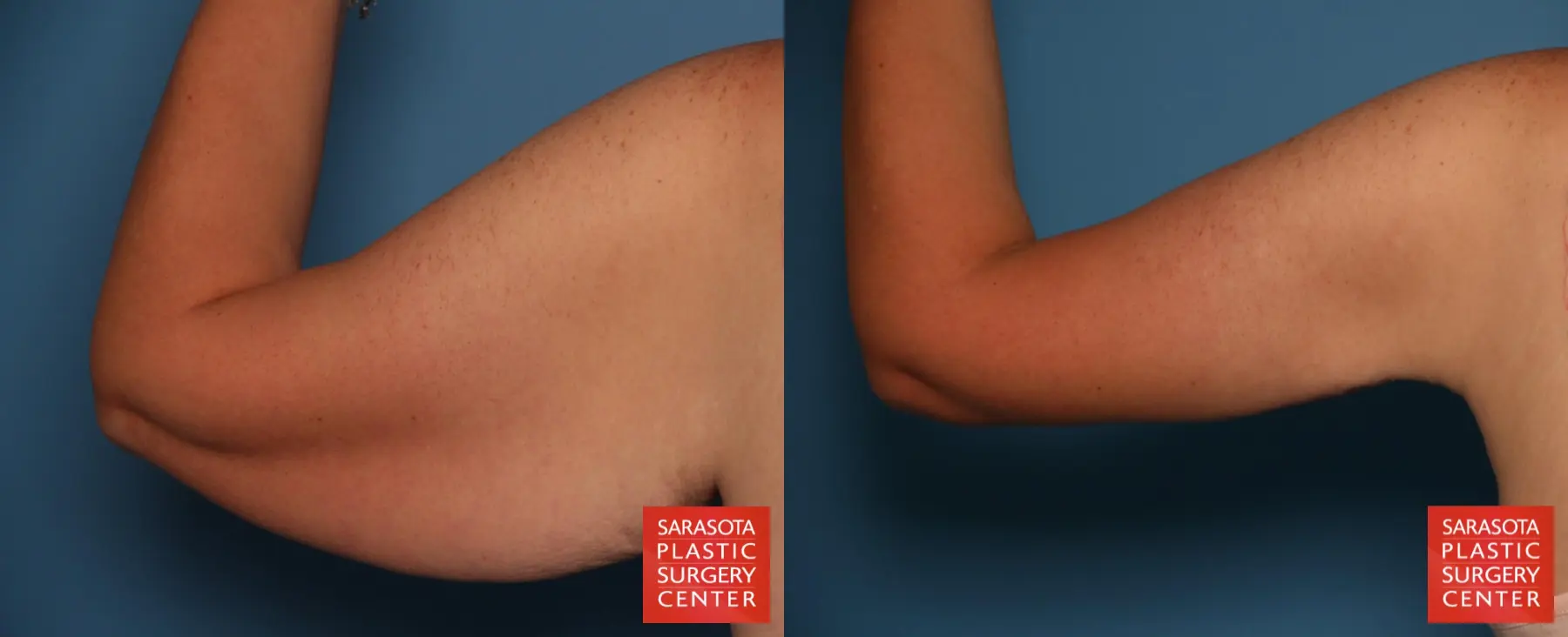 Arm Lift: Patient 25 - Before and After 6