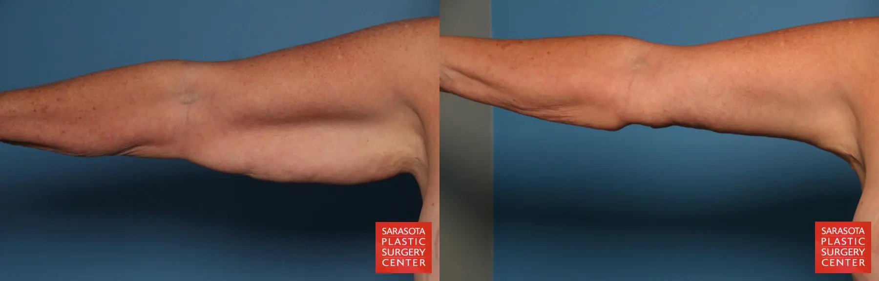 Arm Lift: Patient 31 - Before and After 1