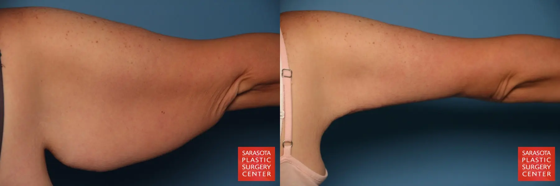 Arm Lift: Patient 25 - Before and After 7