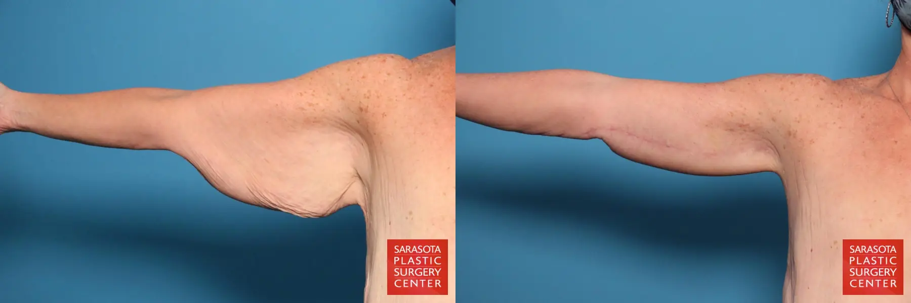 Arm Lift: Patient 28 - Before and After  