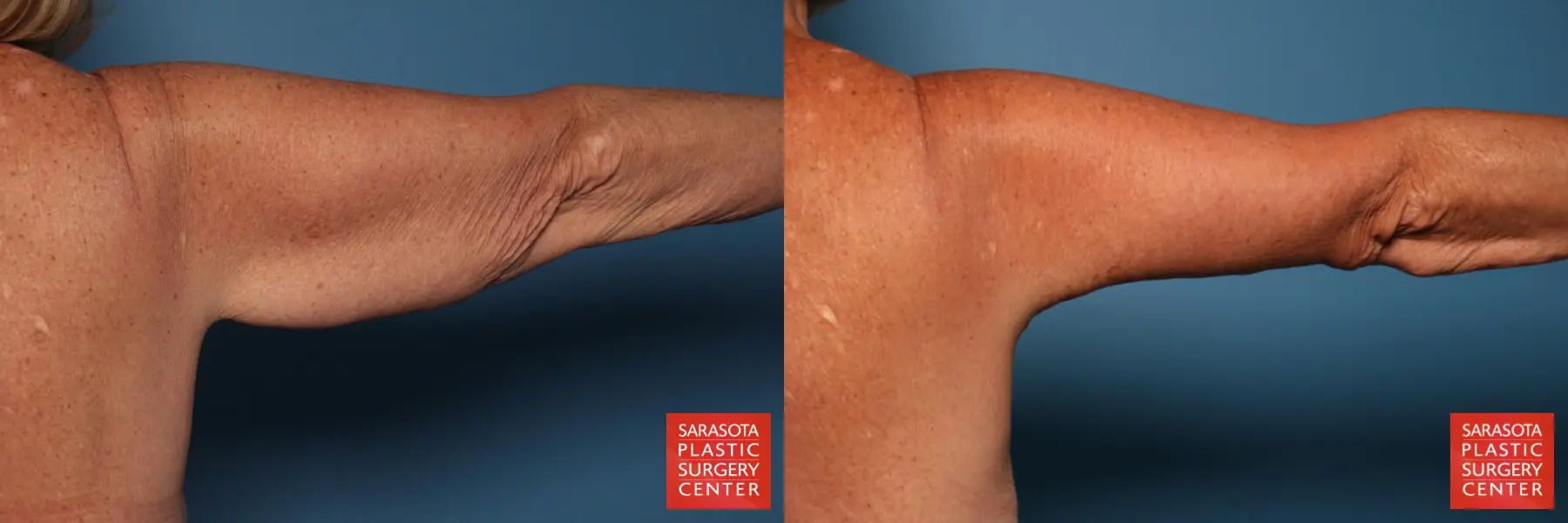 Arm Lift: Patient 31 - Before and After 7