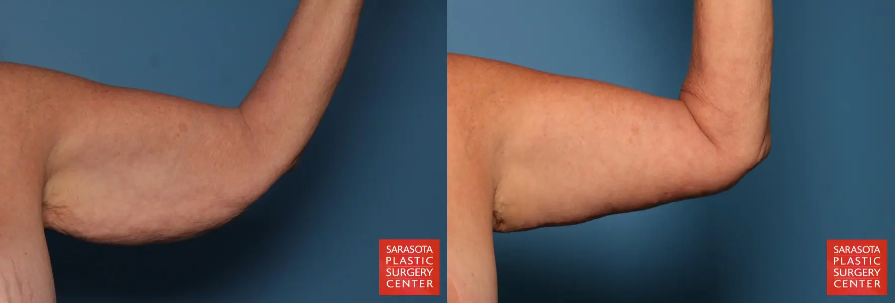 Arm Lift: Patient 31 - Before and After 4