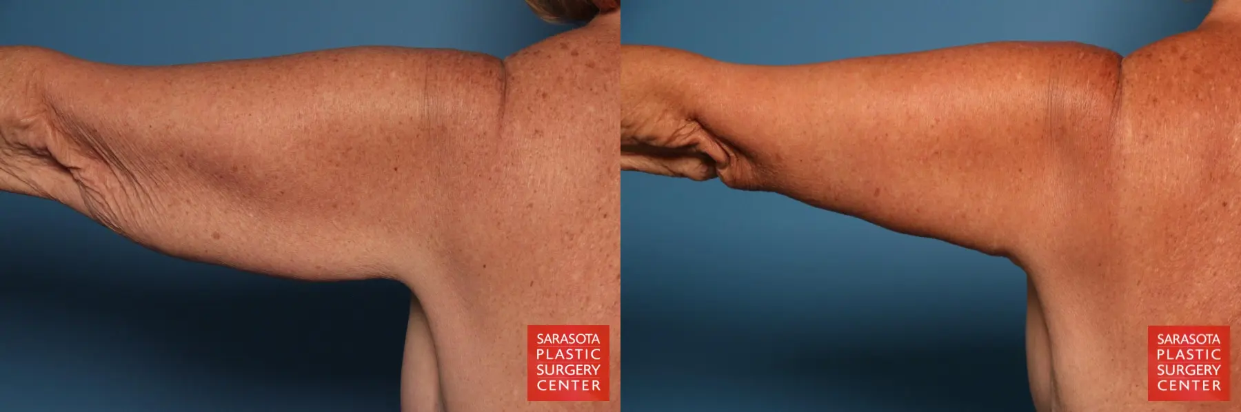 Arm Lift: Patient 31 - Before and After 5