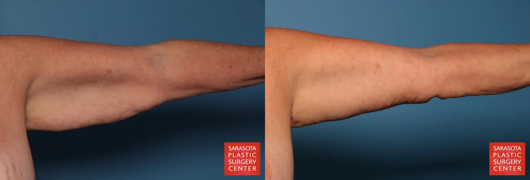 Arm Lift: Patient 31 - Before and After 3