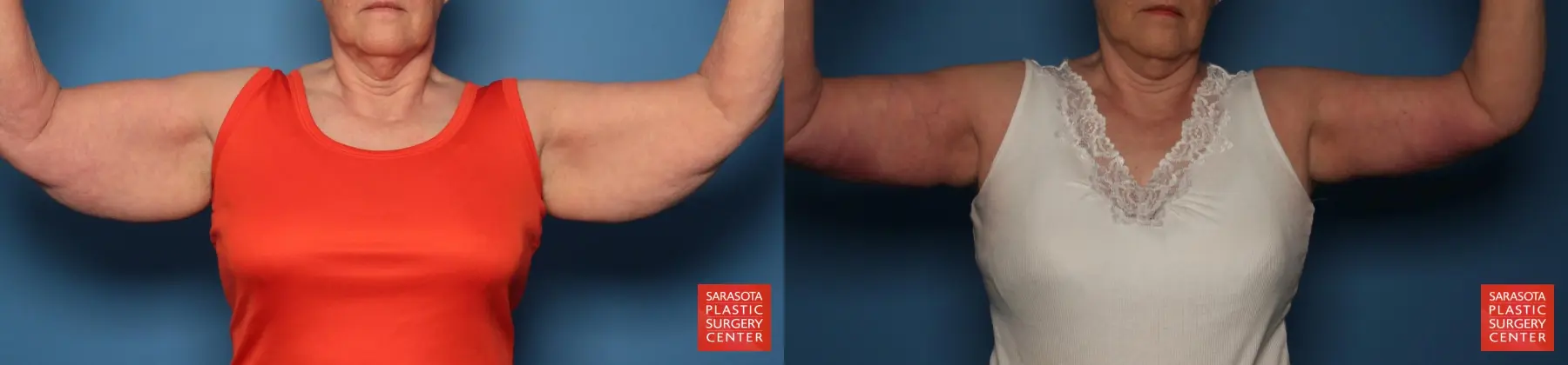 Arm Lift: Patient 12 - Before and After  