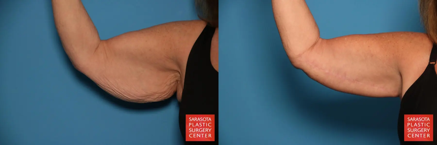 Arm Lift: Patient 23 - Before and After 2