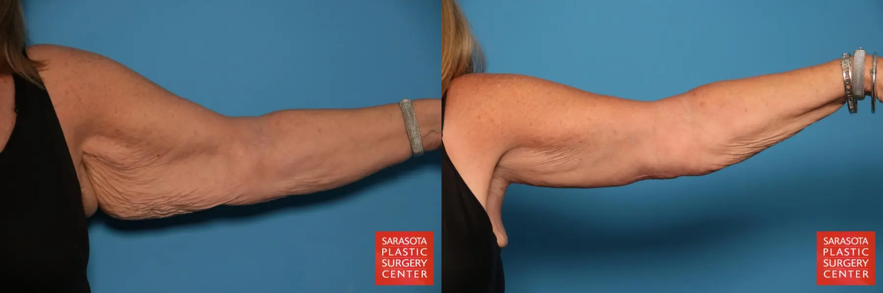 Arm Lift: Patient 23 - Before and After 3