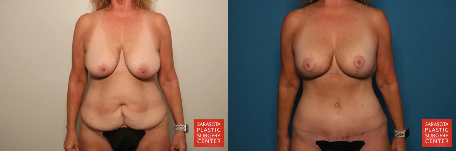 Body Lift: Patient 2 - Before and After  