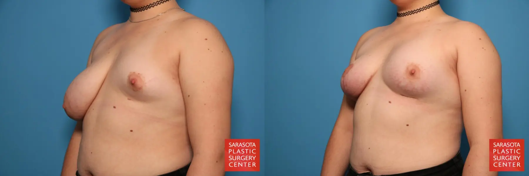 Breast Asymmetry: Patient 8 - Before and After 2