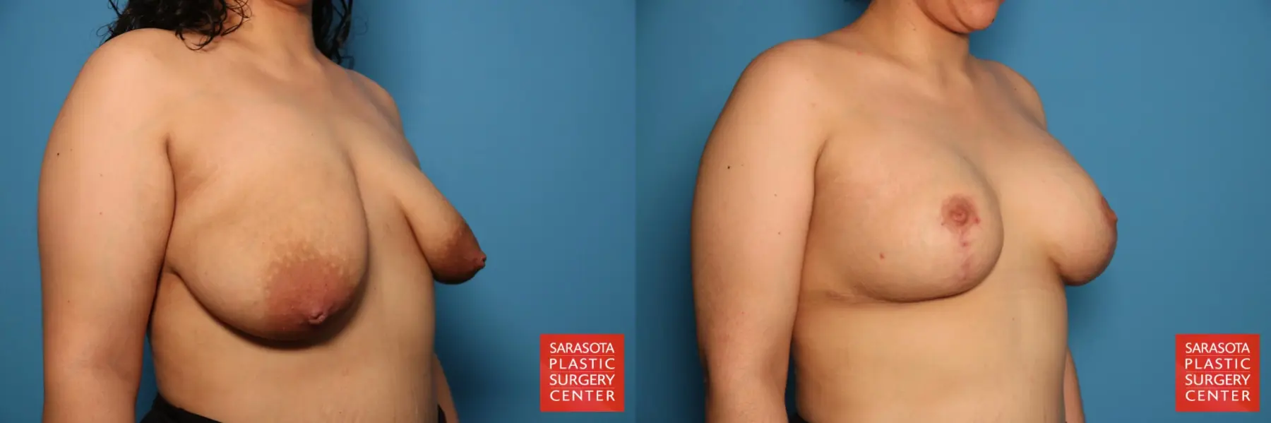 Breast Asymmetry: Patient 7 - Before and After 2