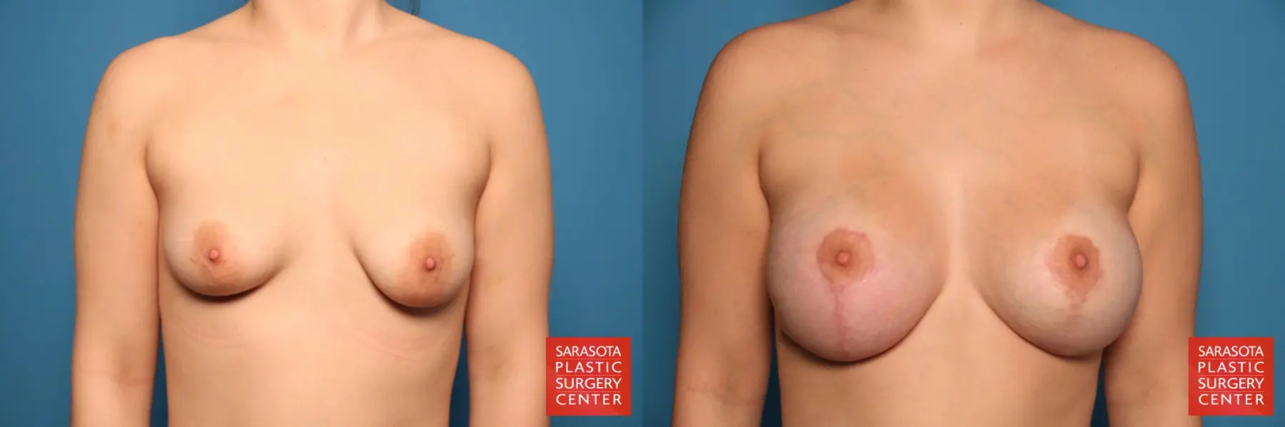 Breast Asymmetry: Patient 6 - Before and After  