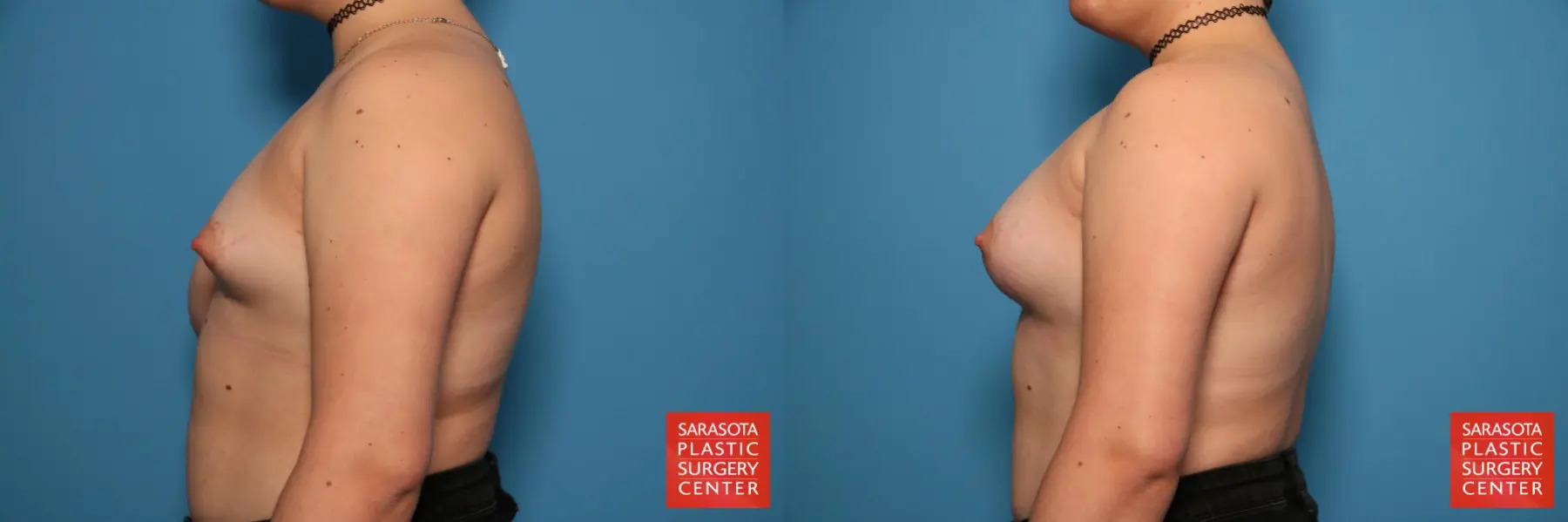 Breast Asymmetry: Patient 8 - Before and After 3