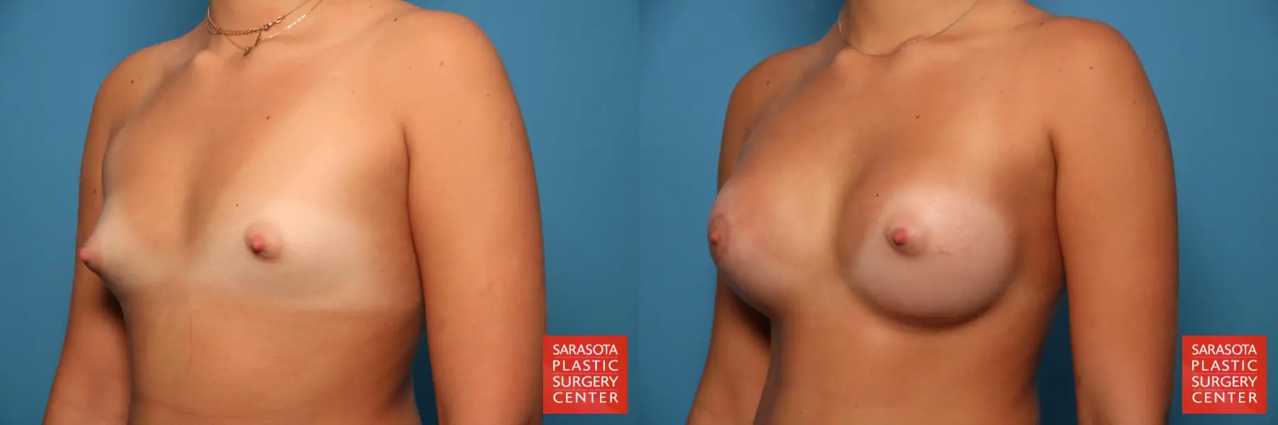 Breast Asymmetry: Patient 1 - Before and After 2
