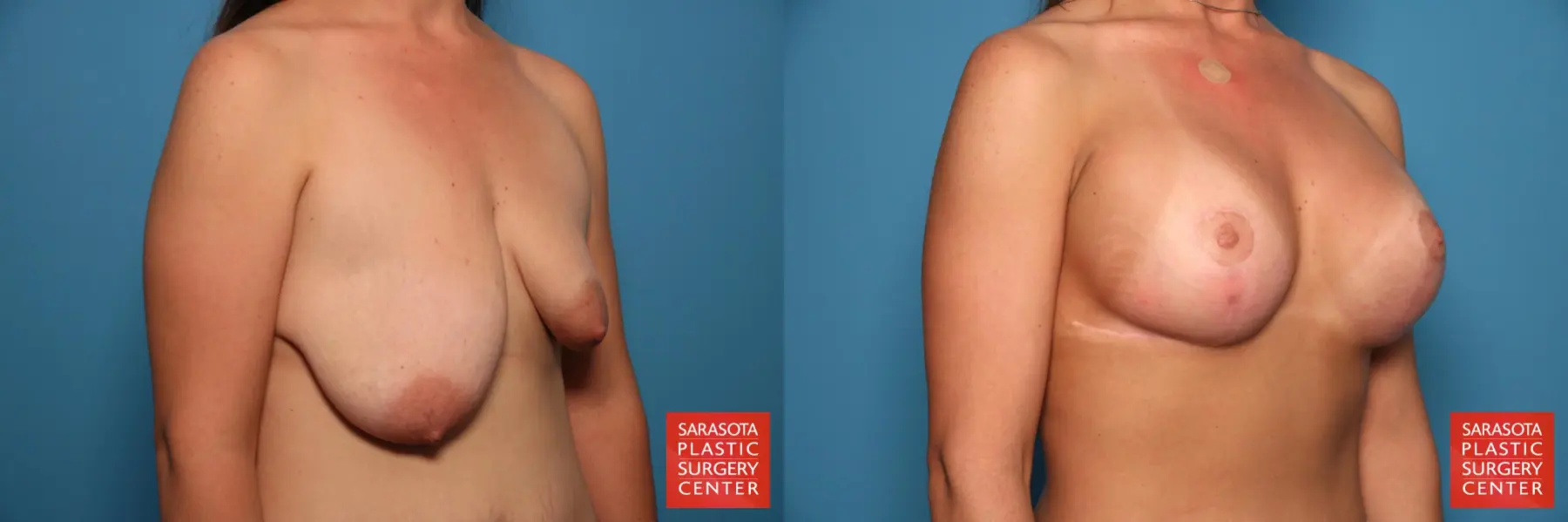 Breast Asymmetry: Patient 2 - Before and After 4