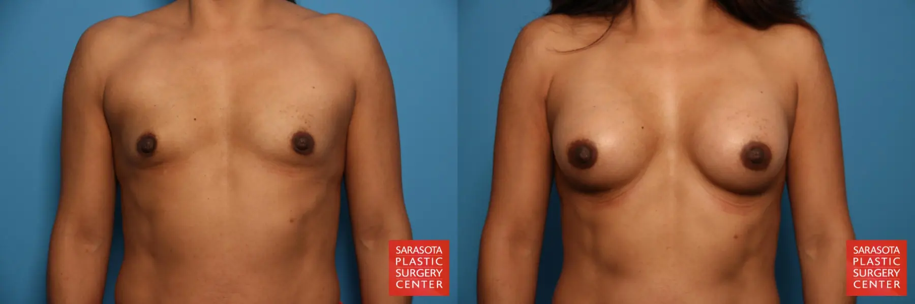 Breast Augmentation - Subfascial: Patient 3 - Before and After  