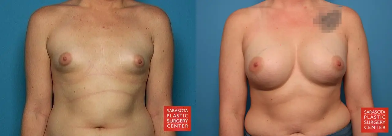 Breast Augmentation - Subfascial: Patient 5 - Before and After  