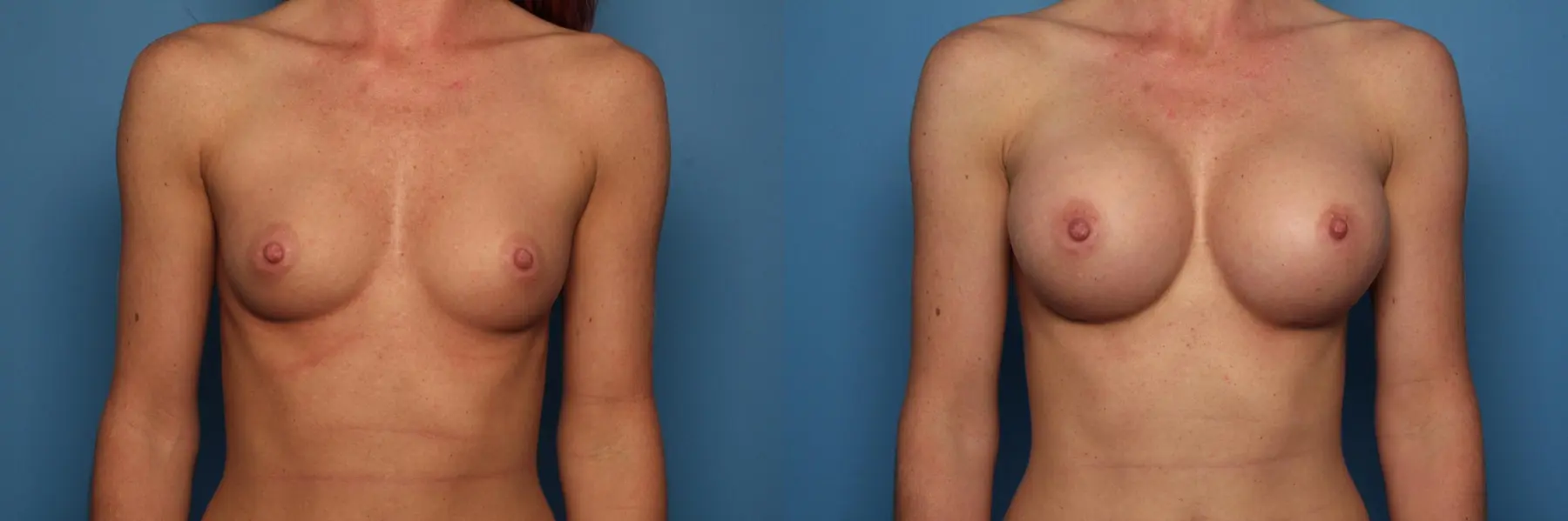 Breast Augmentation: Patient 22 - Before and After  