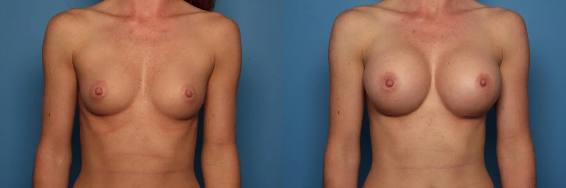 Breast Augmentation: Patient 9 - Before and After  