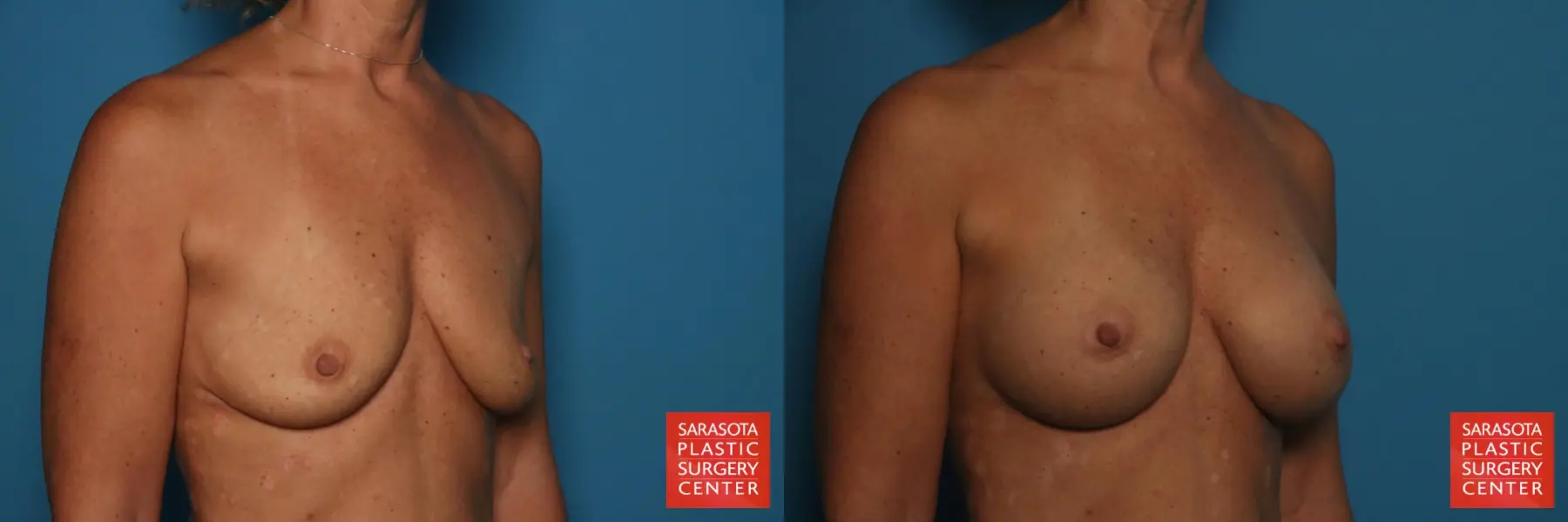 Breast Augmentation: Patient 169 - Before and After 2
