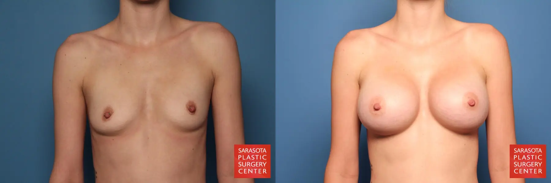 Breast Augmentation: Patient 13 - Before and After  