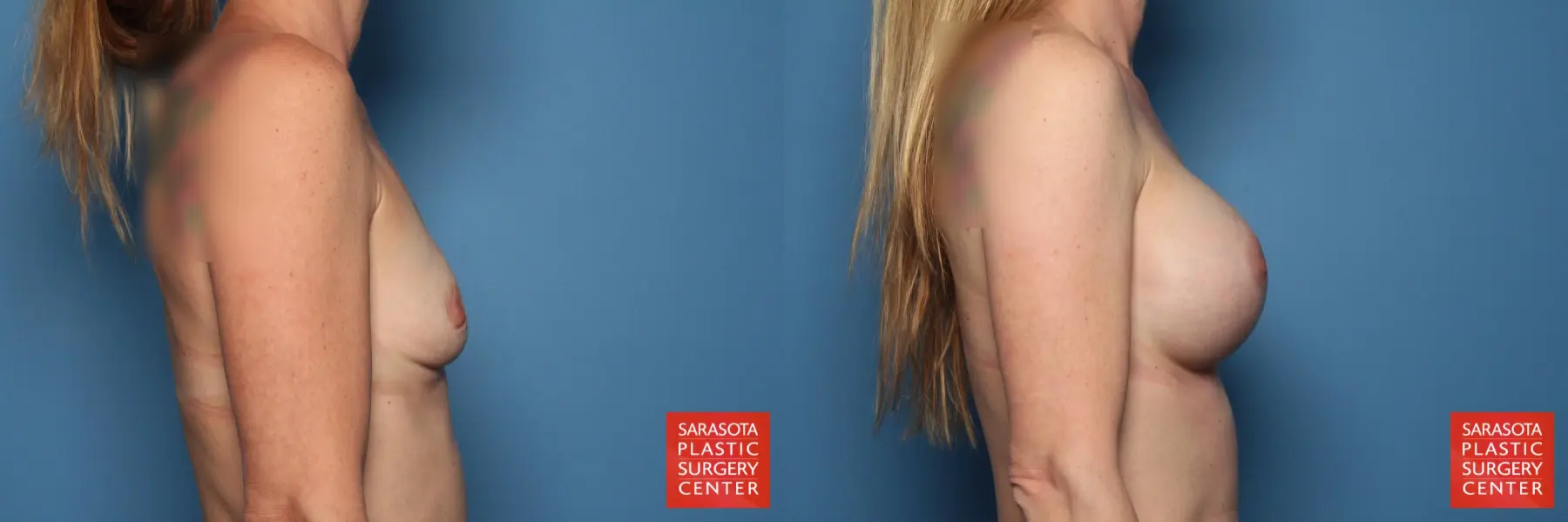 Breast Augmentation: Patient 114 - Before and After 3