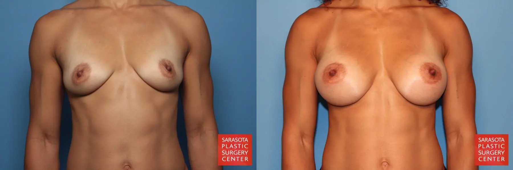 Breast Augmentation: Patient 79 - Before and After 1