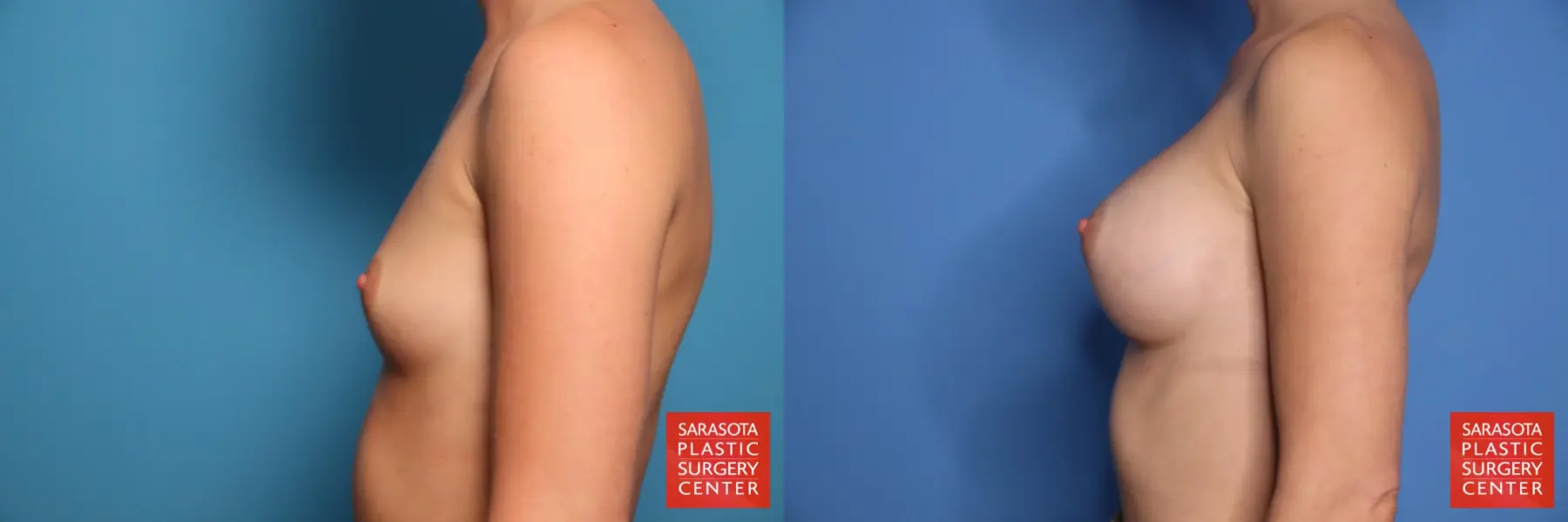 Breast Augmentation: Patient 208 - Before and After 3