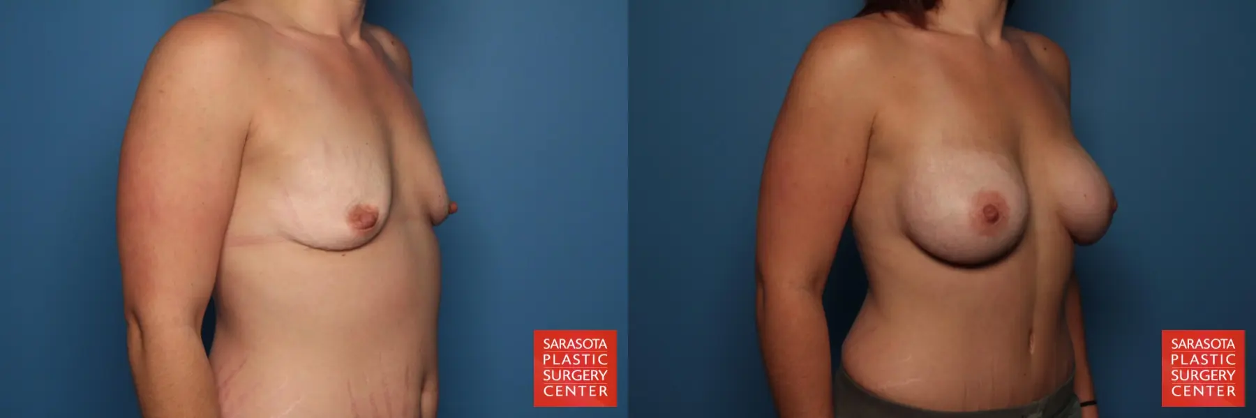 Breast Augmentation: Patient 166 - Before and After 2
