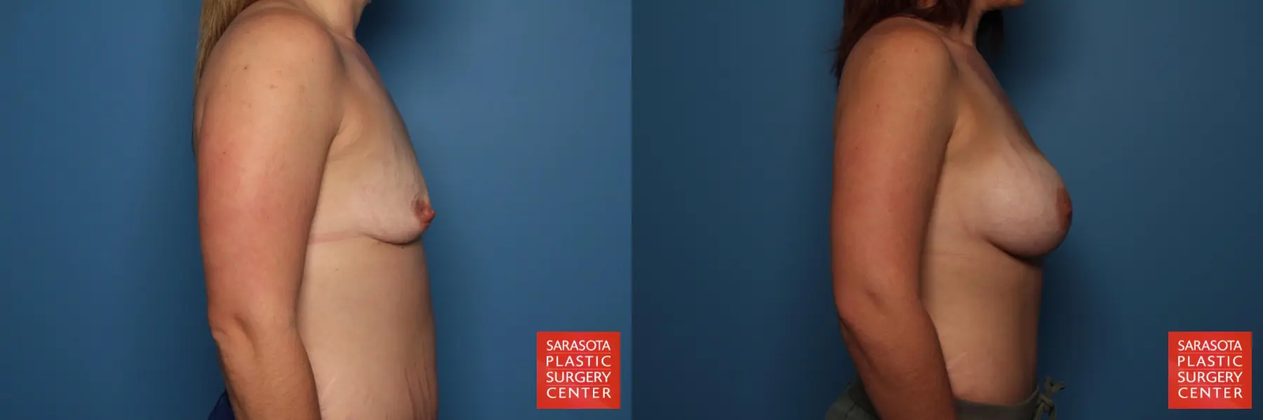 Breast Augmentation: Patient 166 - Before and After 3