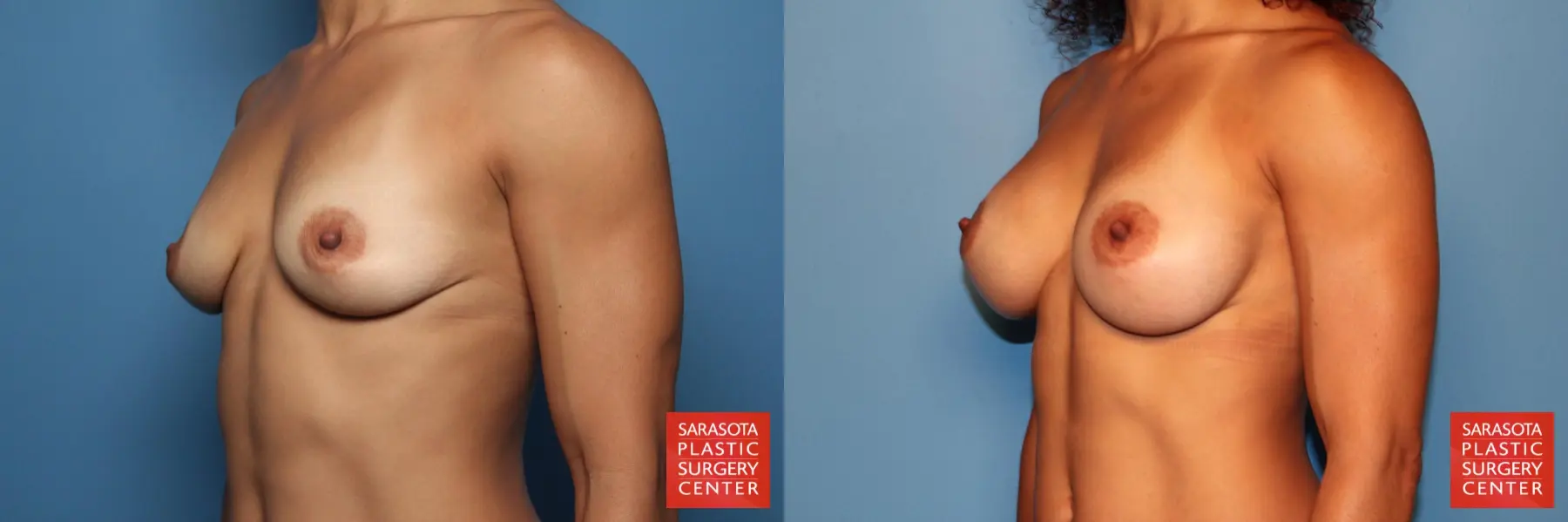 Breast Augmentation: Patient 79 - Before and After 2