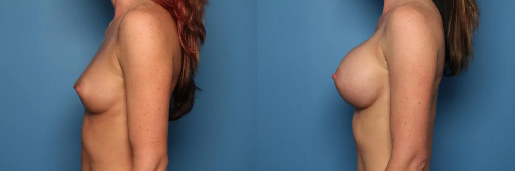 Breast Augmentation: Patient 22 - Before and After 3