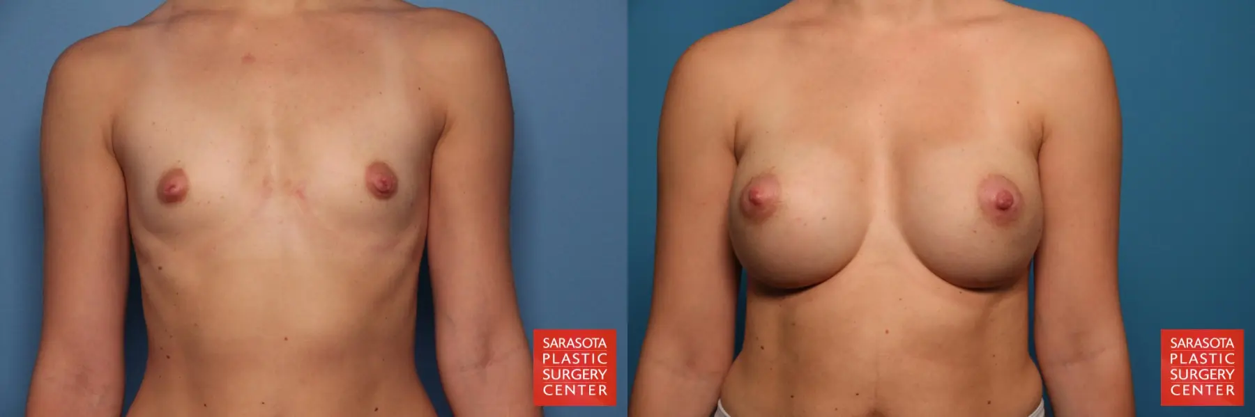 Breast Augmentation: Patient 69 - Before and After 1