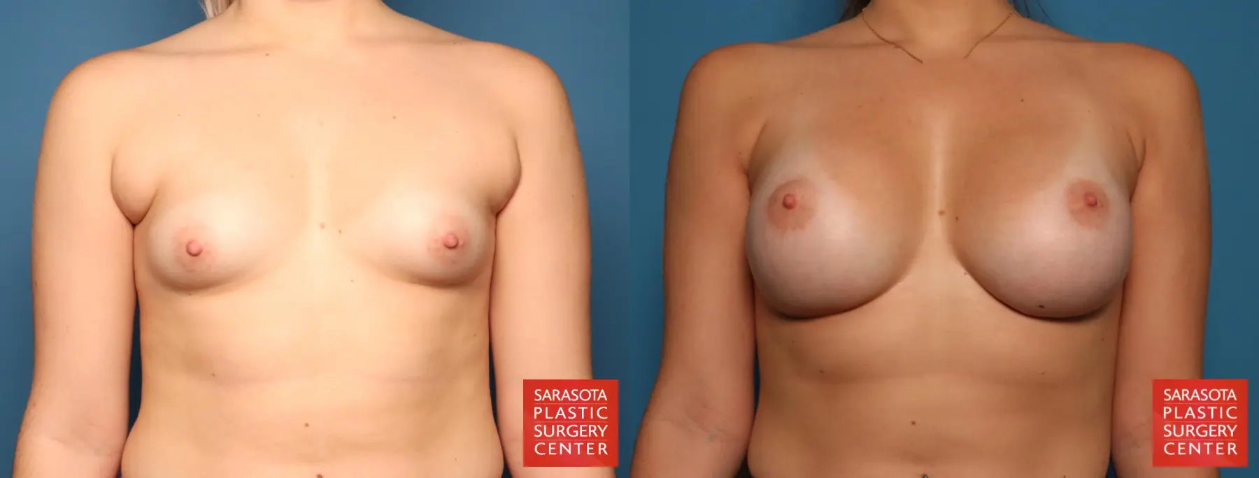 Breast Augmentation: Patient 184 - Before and After 1