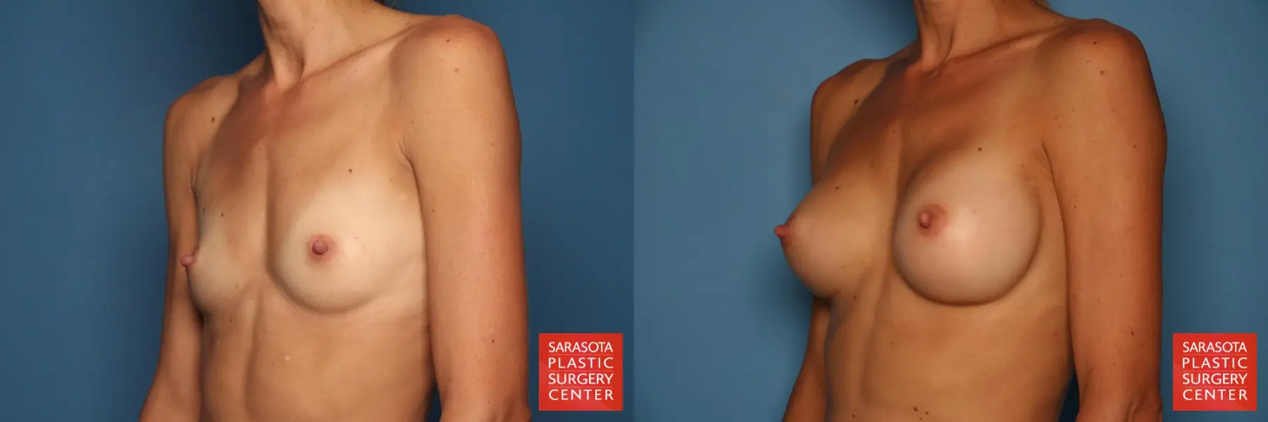 Breast Augmentation: Patient 122 - Before and After 2