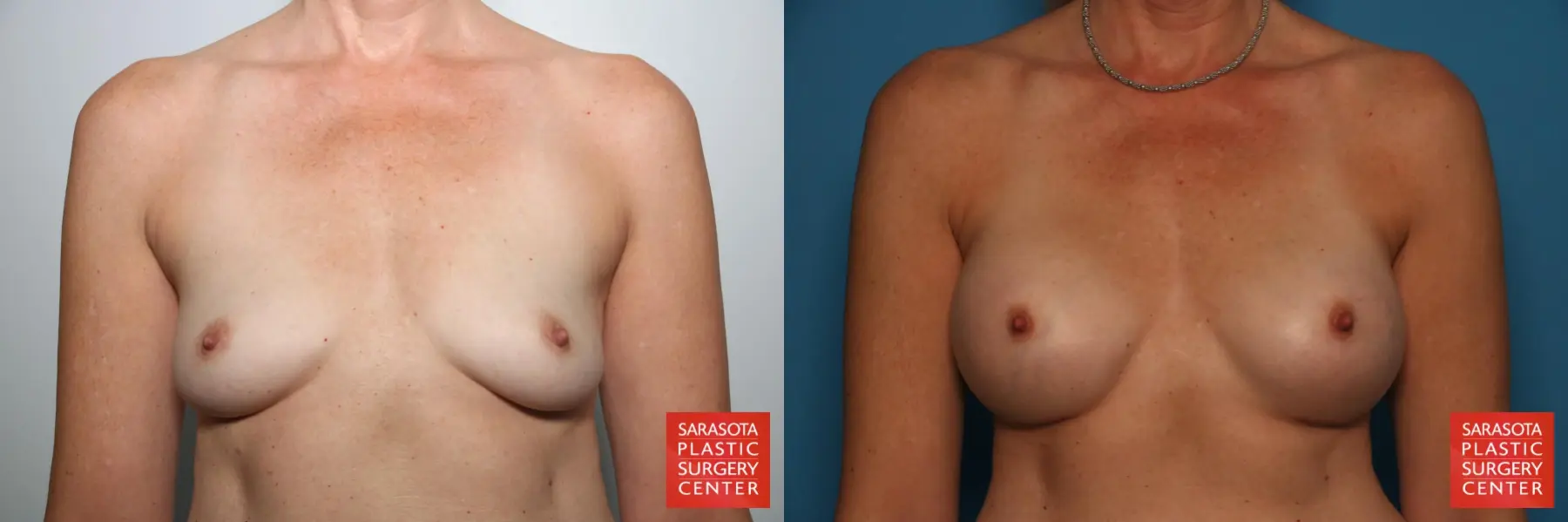 Breast Augmentation: Patient 167 - Before and After  