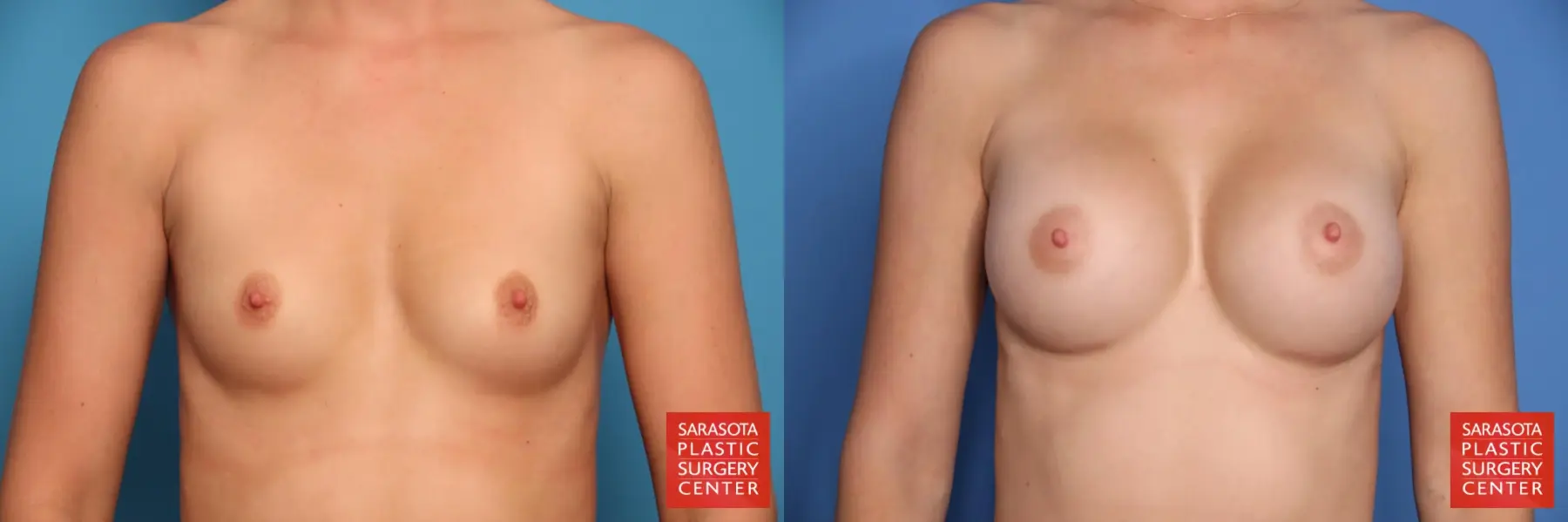 Breast Augmentation: Patient 208 - Before and After 1