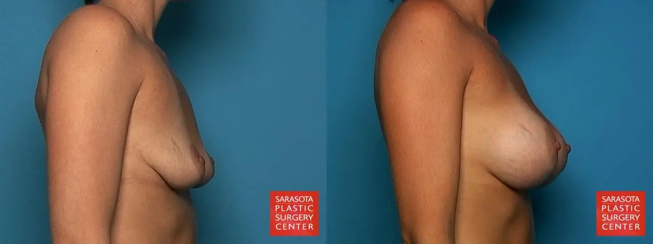 Breast Augmentation: Patient 63 - Before and After 3