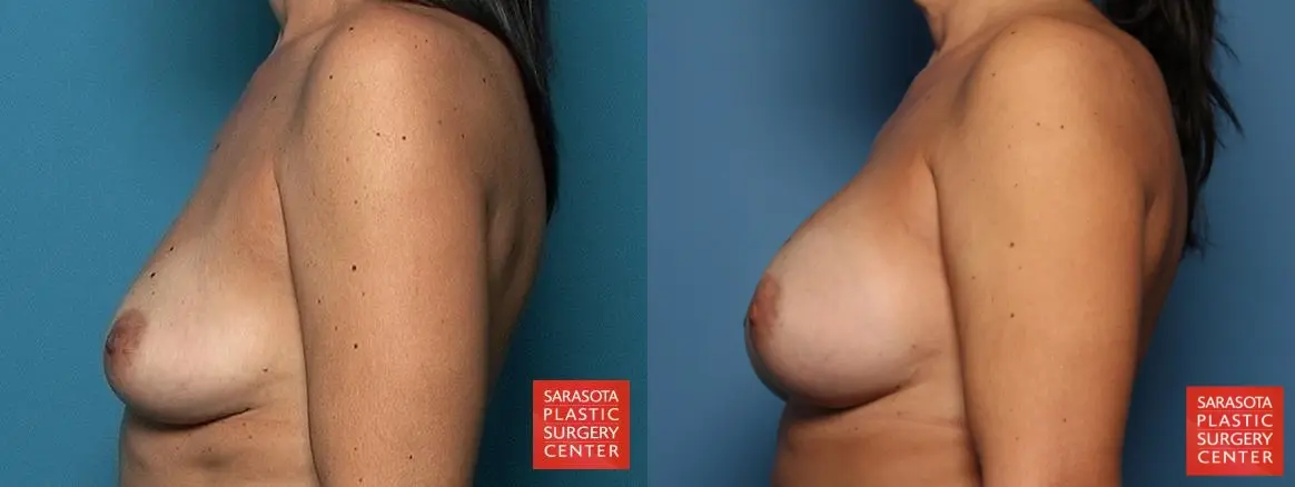 Breast Augmentation: Patient 80 - Before and After 3