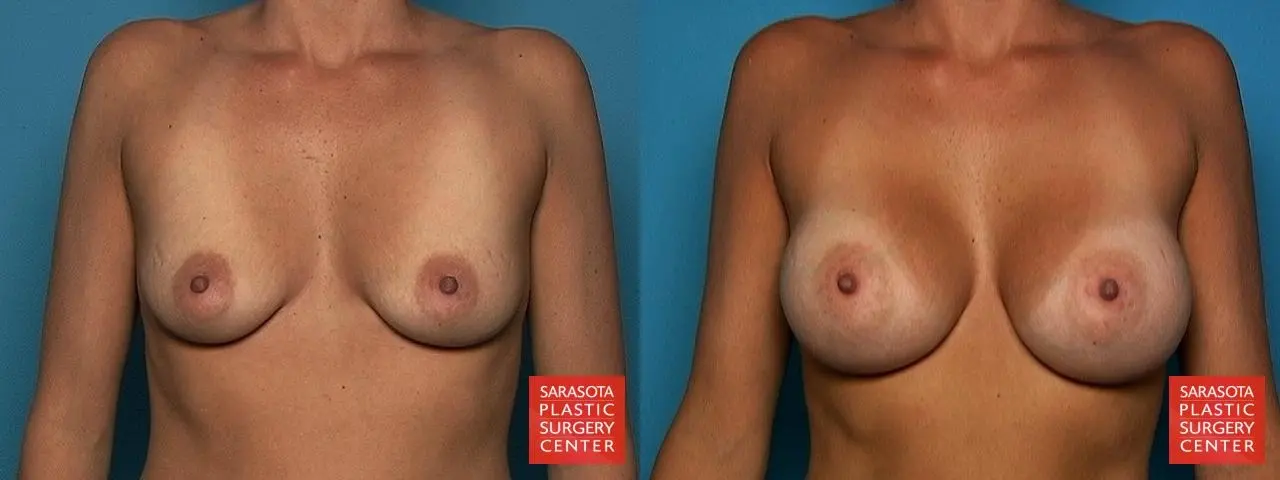 Breast Augmentation: Patient 63 - Before and After 1