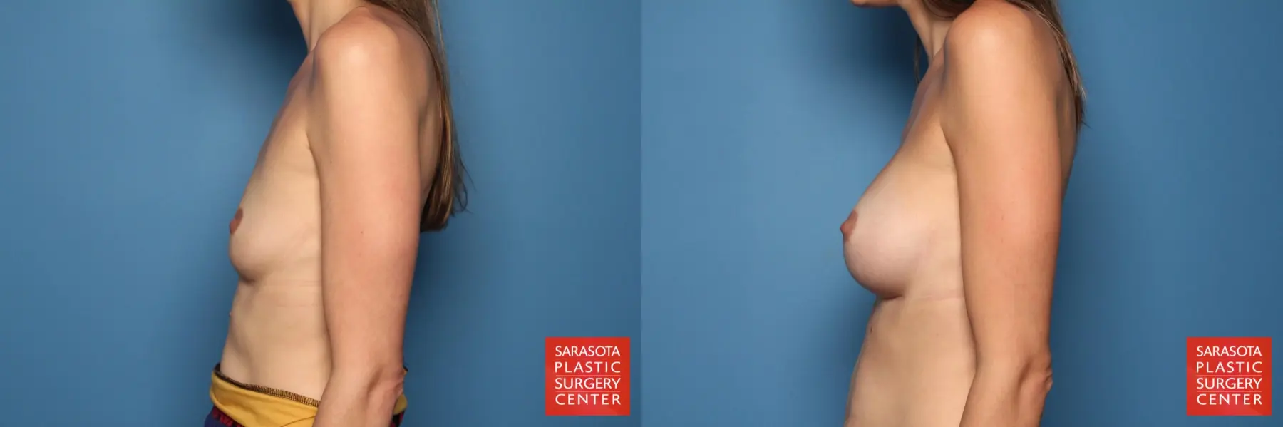 Breast Augmentation: Patient 33 - Before and After 3