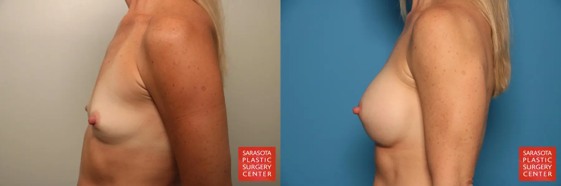Breast Augmentation: Patient 164 - Before and After 3