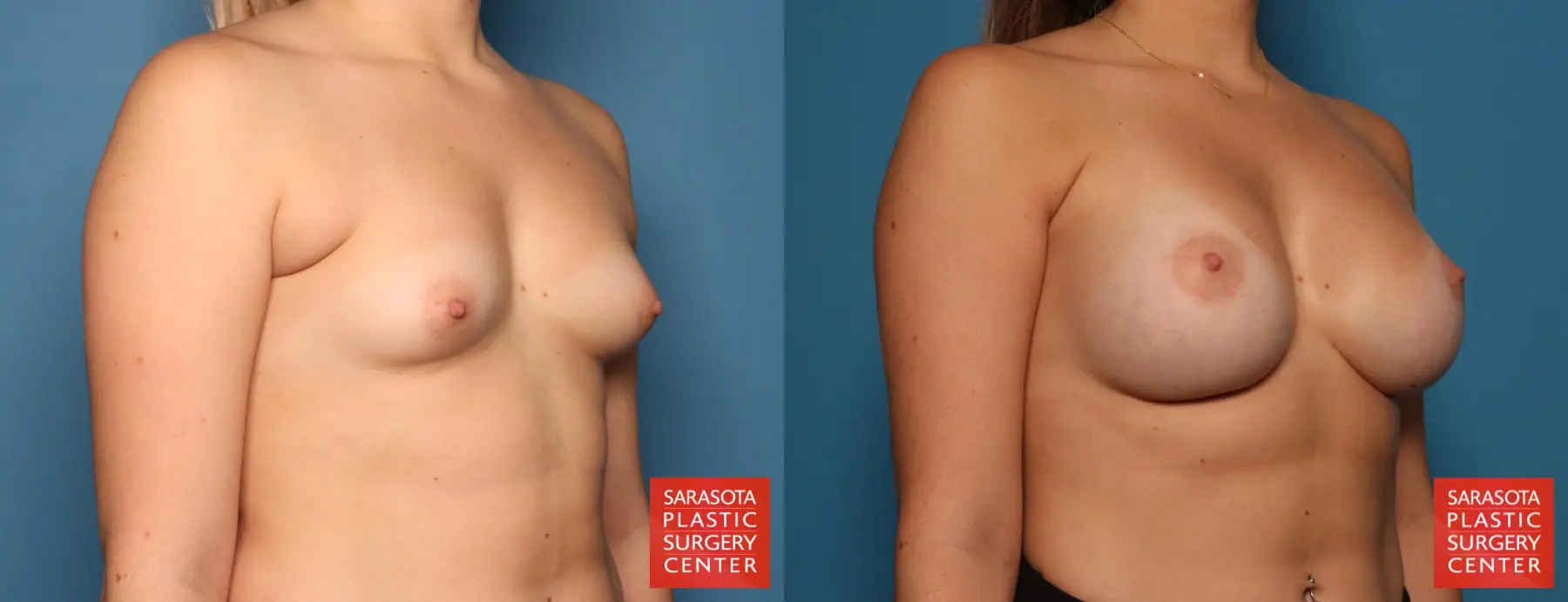 Breast Augmentation: Patient 184 - Before and After 2