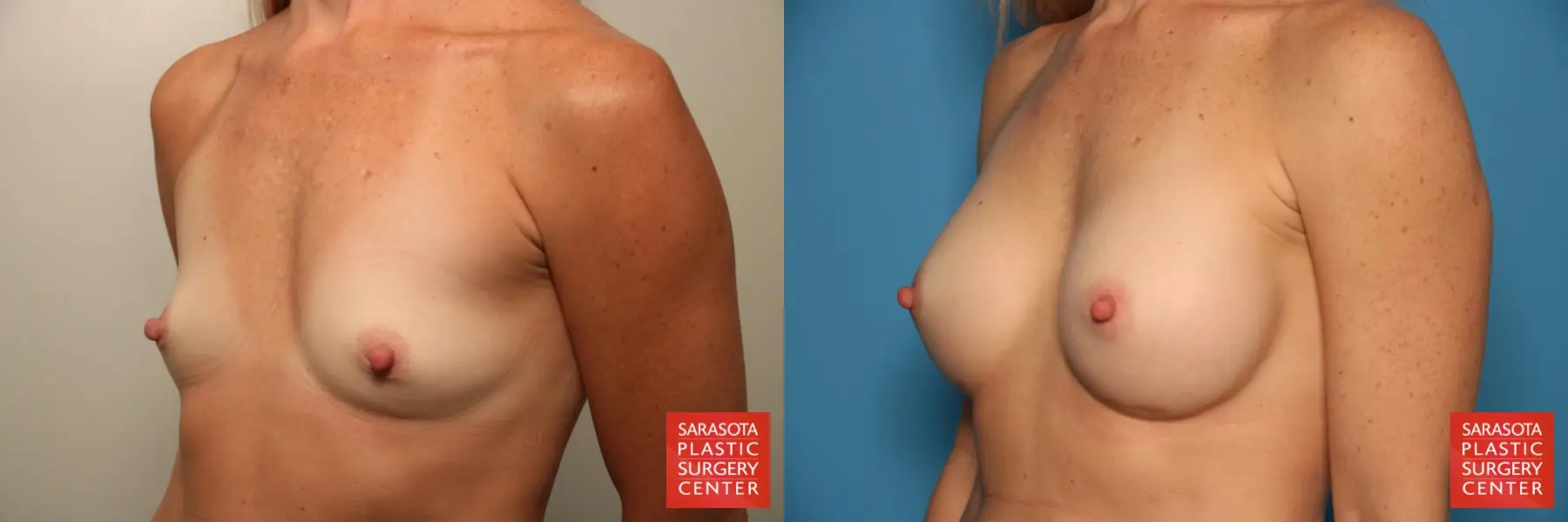 Breast Augmentation: Patient 164 - Before and After 2