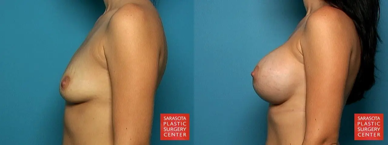 Breast Augmentation: Patient 31 - Before and After 3