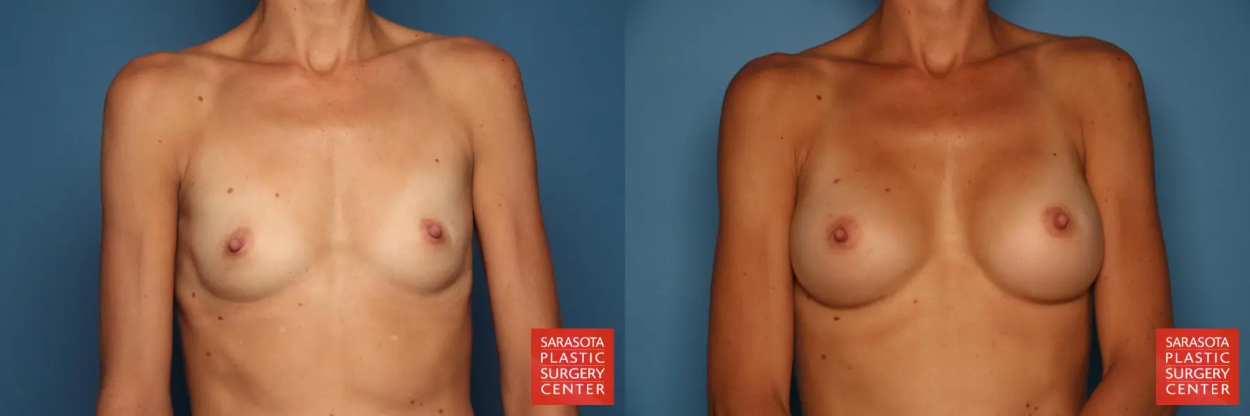 Breast Augmentation: Patient 122 - Before and After 1